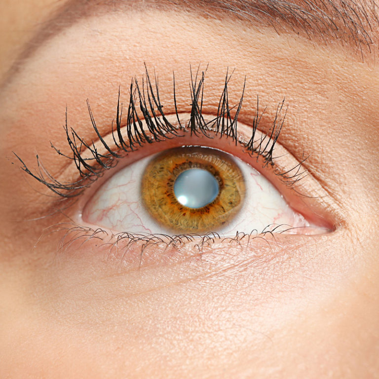 Epigenetika a zdraví očí I. – Prevence šedého zákalu