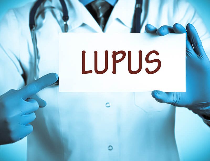 epivyziva-lexikon-nemoci-lupus