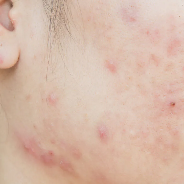 epivyziva-lexikon-nemoci--akne